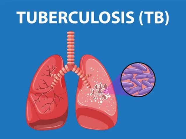 Tuberculosis Fight Jeopardized by Funding Cuts, Says WHO