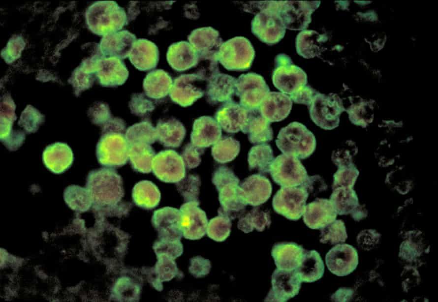 Eight-year-old dies after brain-eating amoeba in Louisiana